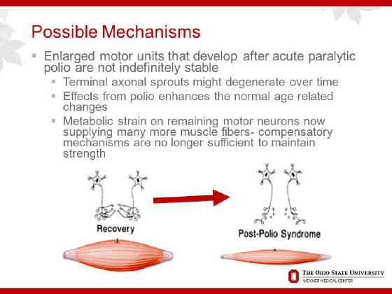 2015OPNConferenceDAdamQuickPostPolioSyndrome/Slide11.JPG