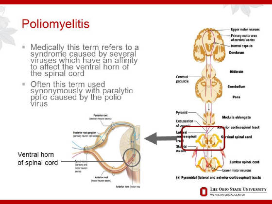 2015OPNConferenceDAdamQuickPostPolioSyndrome/Slide4.JPG