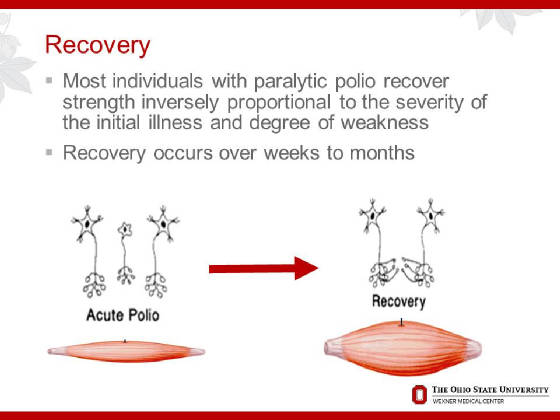 2015OPNConferenceDAdamQuickPostPolioSyndrome/Slide6.JPG